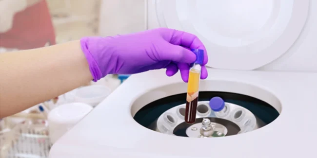 PRP Therapy for Fertility