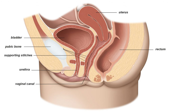 Burch colposuspension