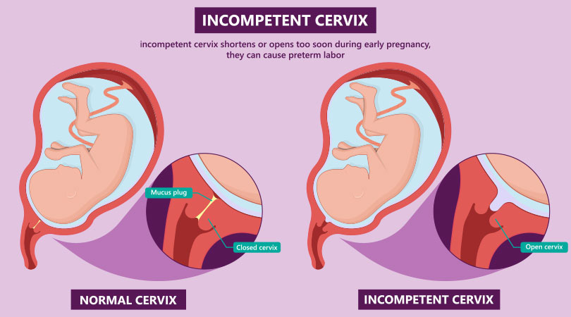 Cervical Incompetence