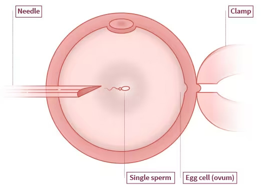 Intra Cytoplasmic Sperm Injection (ICSI)