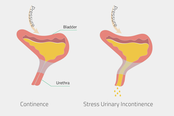 Stress Urinary